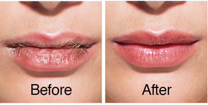 10-ways-to-get-rid-of-chapped-lips-health-mind